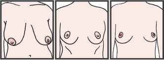 Types of Separated Breasts