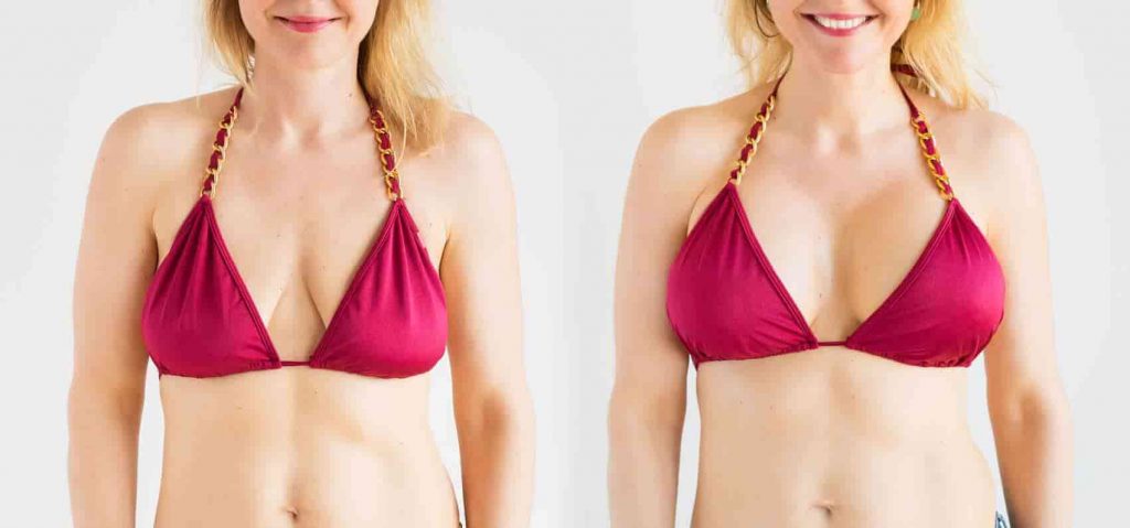nonsurgical breast lifts